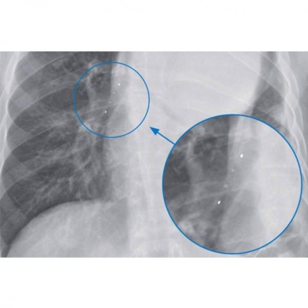 Novatech Tracheobronchial GSS stent,  4-12-14mm, 7.5-20-7.5mm